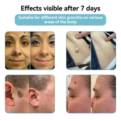☂TrackMuller® VelvetSkin+Series ⚔️All-in-One Laser Eraser Pen🖊️ (🔬Powered by CO₂ laser technology – effectively removes moles, warts, skin tags, pigmentation spots, and other skin imperfections)