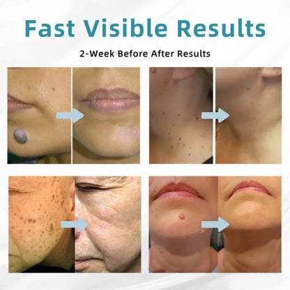 ☂TrackMuller® VelvetSkin+Series ⚔️All-in-One Laser Eraser Pen🖊️ (🔬Powered by CO₂ laser technology – effectively removes moles, warts, skin tags, pigmentation spots, and other skin imperfections)
