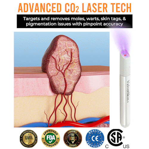 ☂TrackMuller® VelvetSkin+Series ⚔️All-in-One Laser Eraser Pen🖊️ (🔬Powered by CO₂ laser technology – effectively removes moles, warts, skin tags, pigmentation spots, and other skin imperfections)
