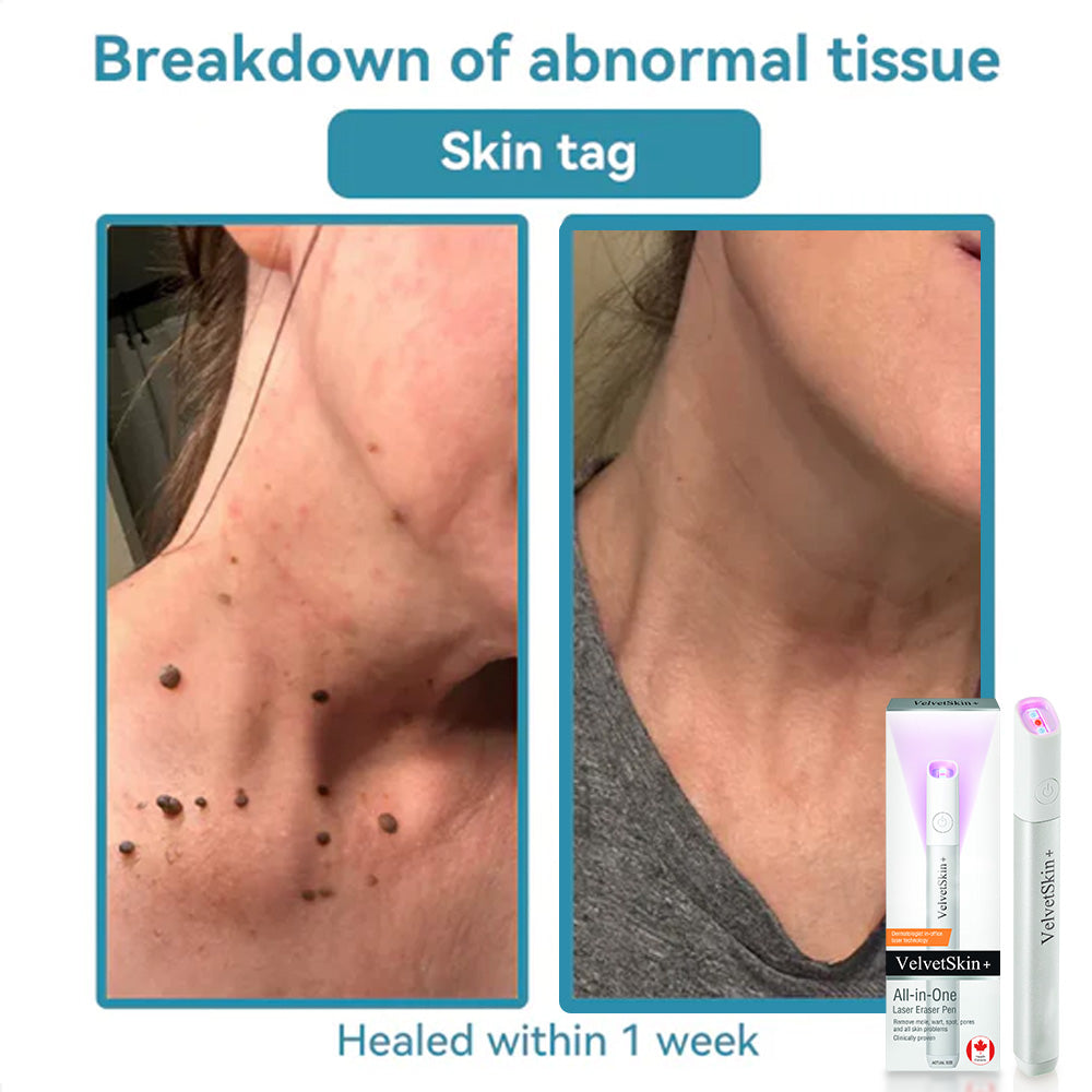 ☂TrackMuller® VelvetSkin+Series ⚔️All-in-One Laser Eraser Pen🖊️ (🔬Powered by CO₂ laser technology – effectively removes moles, warts, skin tags, pigmentation spots, and other skin imperfections)