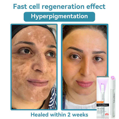 ☂TrackMuller® VelvetSkin+Series ⚔️All-in-One Laser Eraser Pen🖊️ (🔬Powered by CO₂ laser technology – effectively removes moles, warts, skin tags, pigmentation spots, and other skin imperfections)