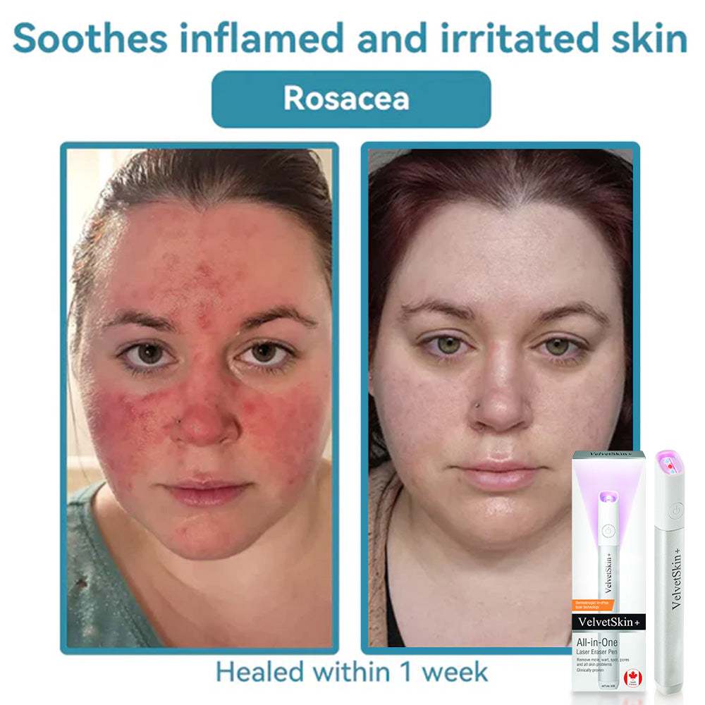 ☂TrackMuller® VelvetSkin+Series ⚔️All-in-One Laser Eraser Pen🖊️ (🔬Powered by CO₂ laser technology – effectively removes moles, warts, skin tags, pigmentation spots, and other skin imperfections)