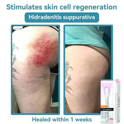 ☂TrackMuller® VelvetSkin+Series ⚔️All-in-One Laser Eraser Pen🖊️ (🔬Powered by CO₂ laser technology – effectively removes moles, warts, skin tags, pigmentation spots, and other skin imperfections)