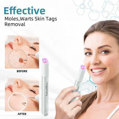 ☂TrackMuller® VelvetSkin+Series ⚔️All-in-One Laser Eraser Pen🖊️ (🔬Powered by CO₂ laser technology – effectively removes moles, warts, skin tags, pigmentation spots, and other skin imperfections)
